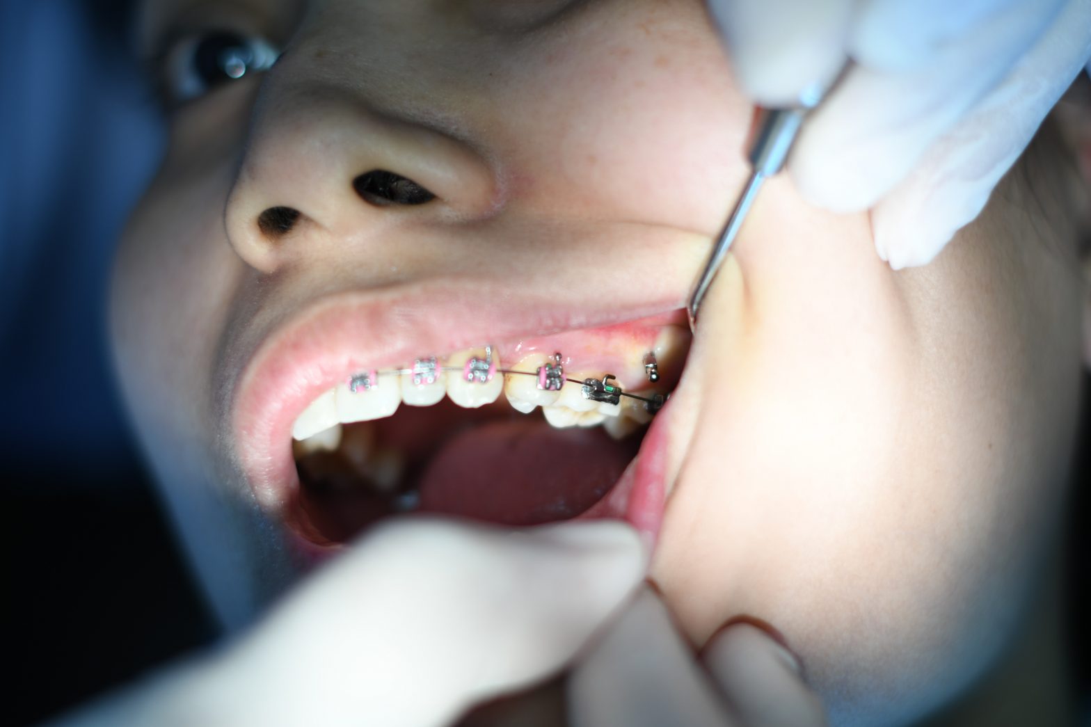 wisdom teeth extraction in Islington