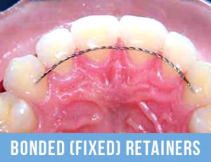 Bonded Fixed retainers