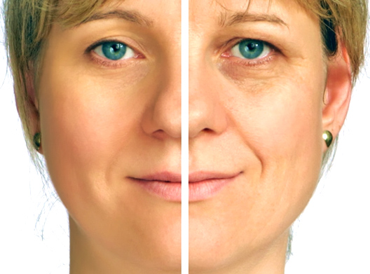Treatment of nasolabial folds Smoothing out fine lines
