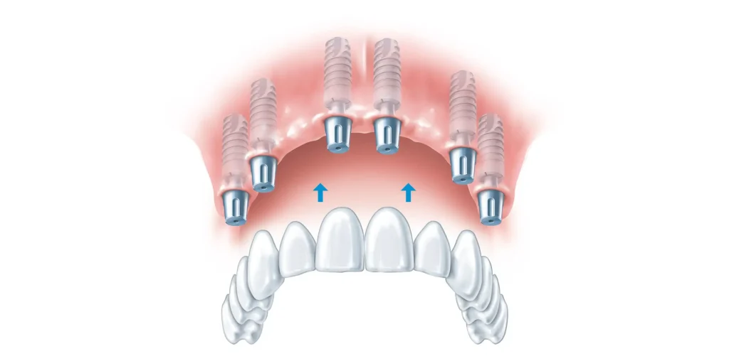 all missing teeth angel smile implant london
