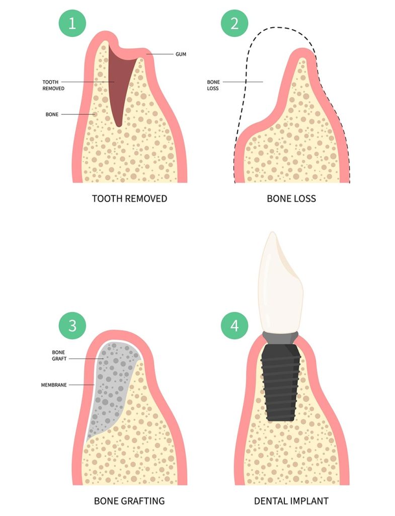 Bone Graft for Dental Implant | Islington & London | fr £500