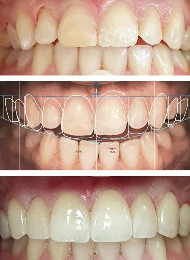 Complete smile makover at Angel Smiles Islington London