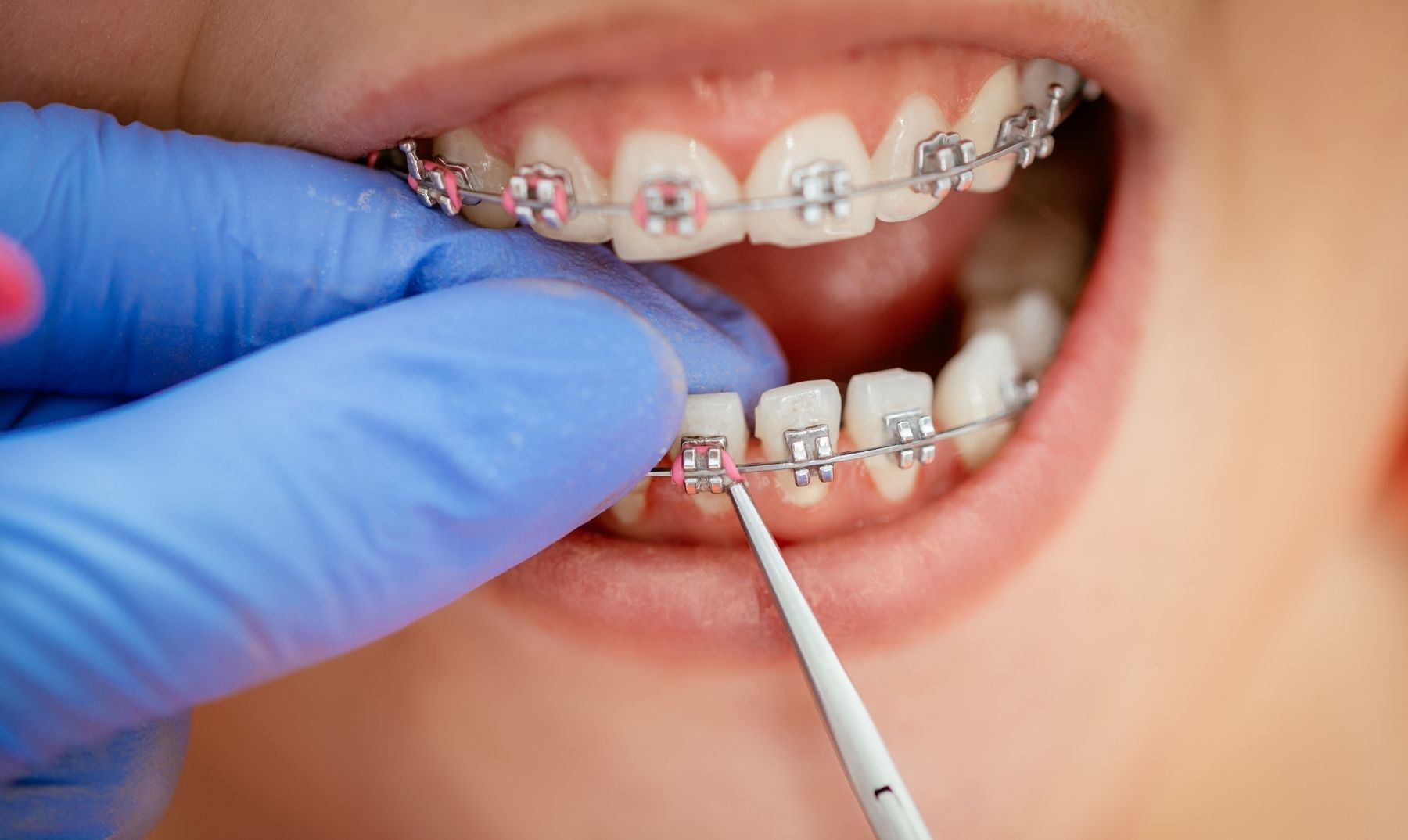 braces