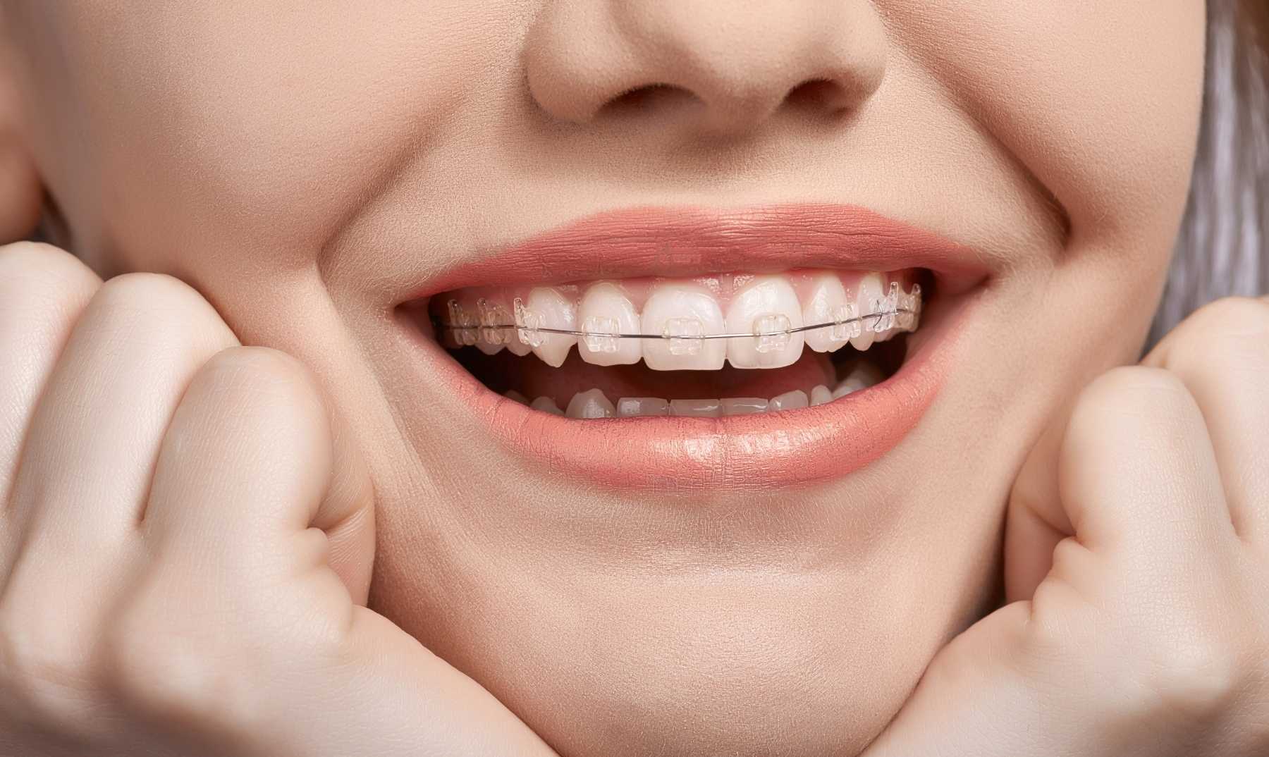Fixed braces