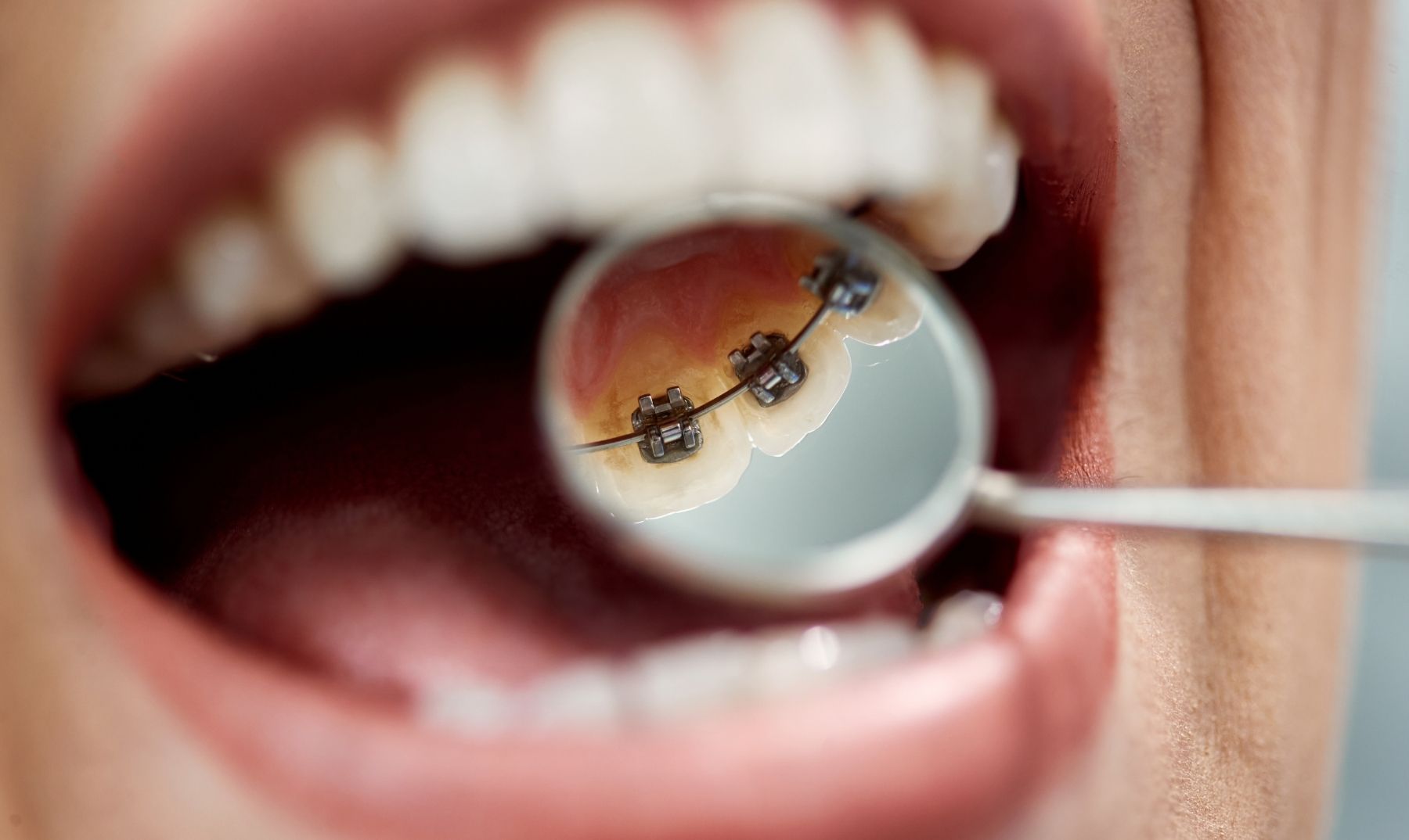 Lingual braces