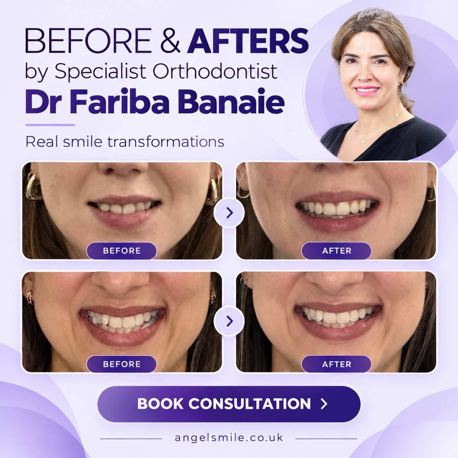 before and after braces