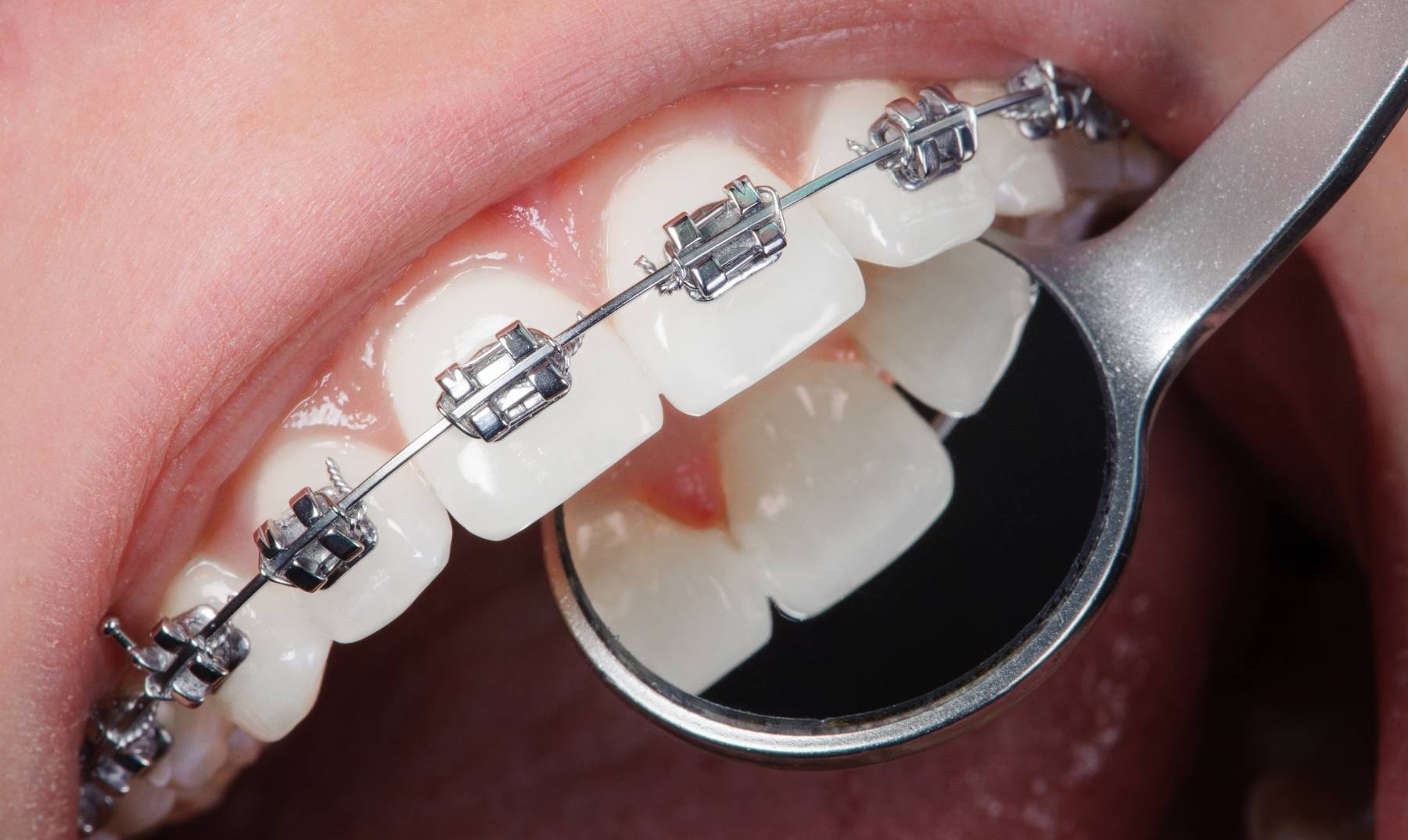 metal braces