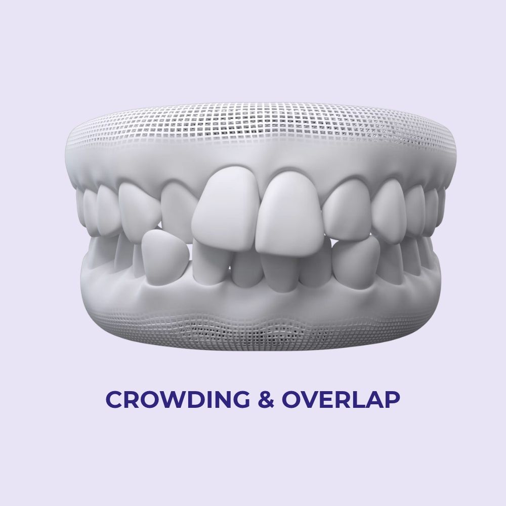 Crowding & overlapping teeth