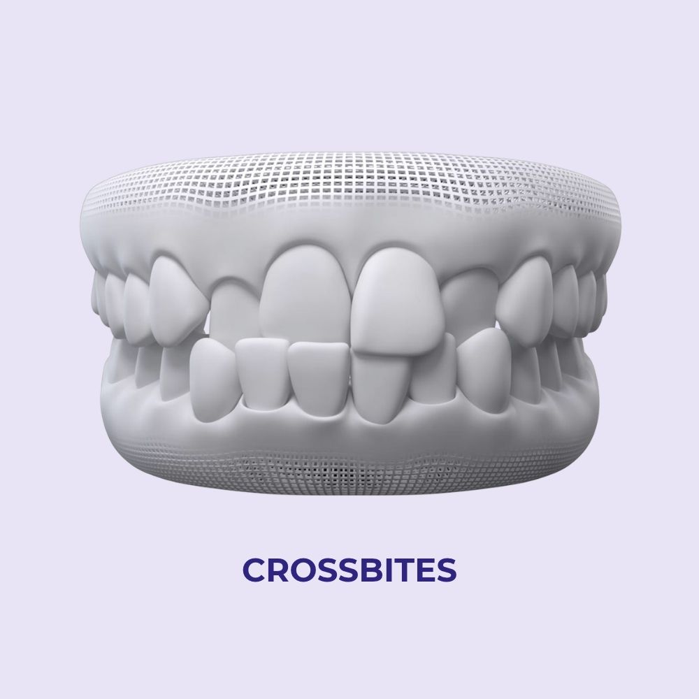 crossbites