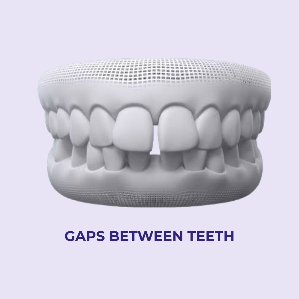 gaps between teeth