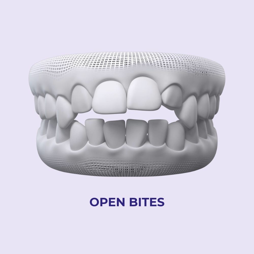 open bites
