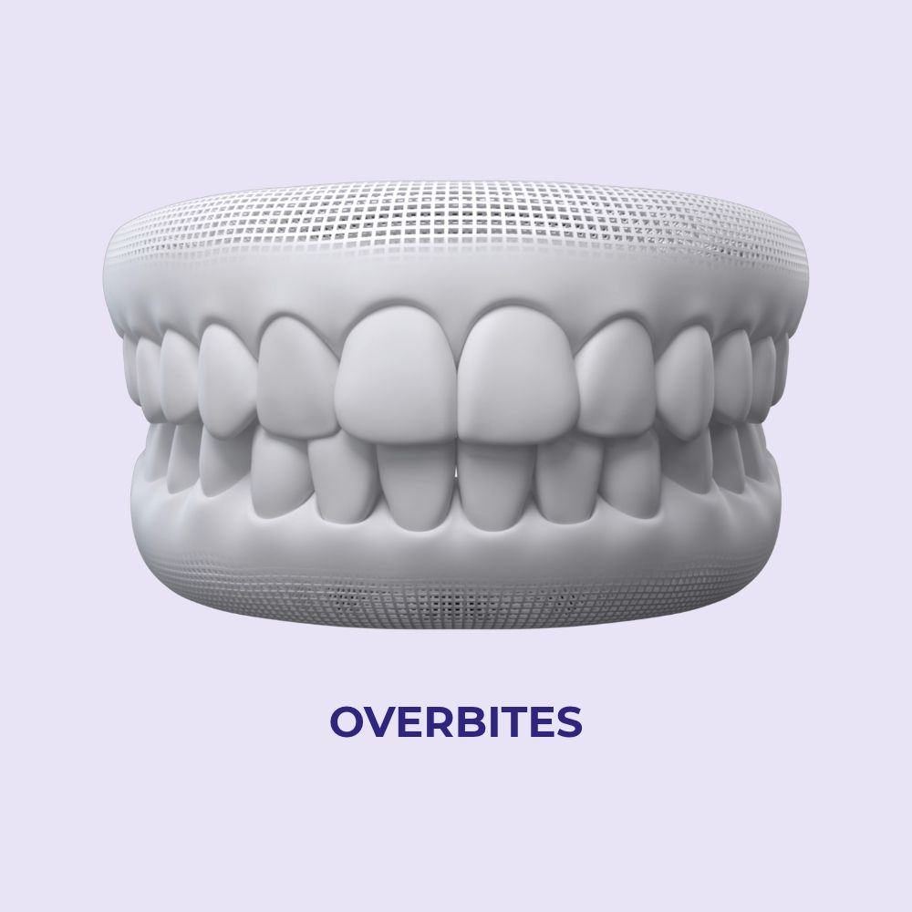 overbites