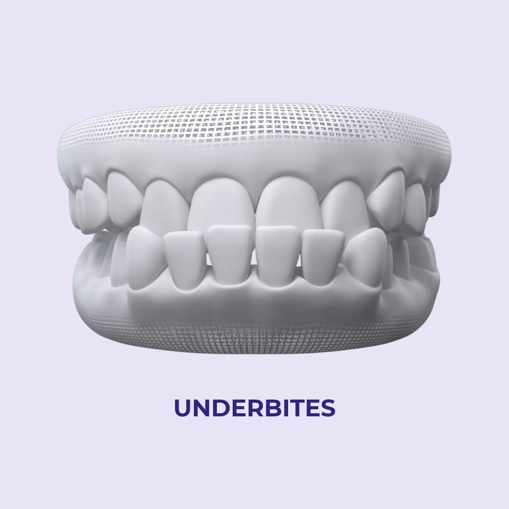 underbites